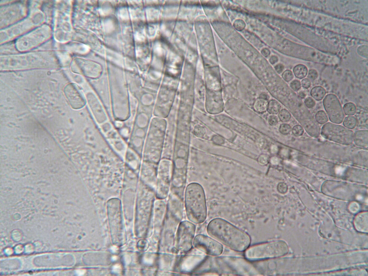 Candida and SIBO: SIFO, Fungal-Bacterial Interaction & Biofilms